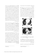 دانلود مقاله ارائه یک الگوریتم مناسب برای استخراج دقیق ناحیه ریه در تصاویر CT به منظور تشخیص کامپیوتری انواع نادولهای ریوی صفحه 2 