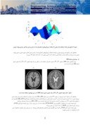 مقاله تشخیص بیماری MS با استفاده از پردازش تصاویر پزشکی صفحه 5 