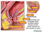 دانلود فایل پاورپوینت هموروئید ( بواسیر ) صفحه 3 