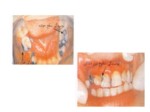 دانلود فایل پاورپوینت پوسیدگی دندان و علت آن صفحه 9 