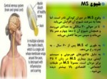 دانلود فایل پاورپوینت بیماری MS صفحه 3 