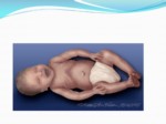 دانلود فایل پاورپوینت روش های حمایت تنفسی در نوزادان نارس صفحه 7 