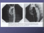 دانلود فایل پاورپوینت انواع بیماریهای قلبی و روش های درمان آنها صفحه 14 