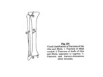 دانلود فایل پاورپوینت شکستگی های ساق در بالغین و اطفال صفحه 4 