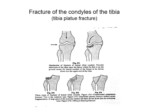 دانلود فایل پاورپوینت شکستگی های ساق در بالغین و اطفال صفحه 9 