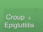 دانلود فایل پاورپوینت بیماری Croup & Epigluttitis صفحه 2 