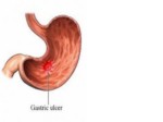 دانلود فایل پاورپوینت گاستریت : Gastritis صفحه 13 