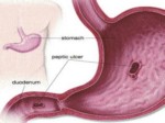 دانلود فایل پاورپوینت گاستریت : Gastritis صفحه 16 