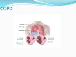 دانلود فایل پاورپوینت بیماریهای مزمن انسدادی ریه COPD صفحه 9 